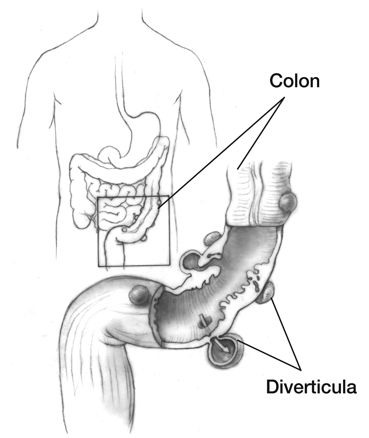 Colon with enlarged view of diverticula projecting through the wall