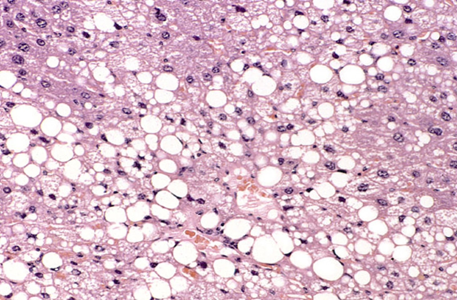 Liver histology showing macrovesicular steatosis