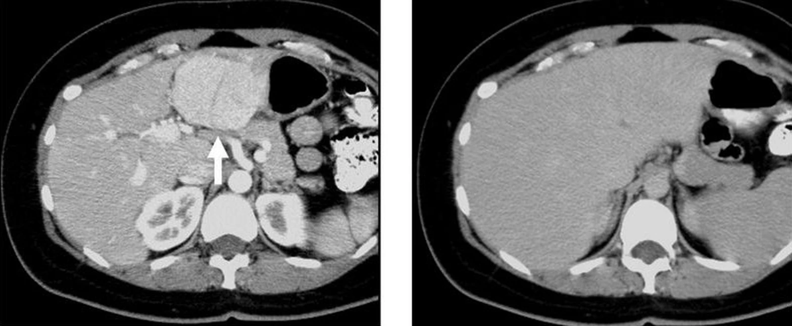 Arterial and portal venous CT phases of focal nodular hyperplasia