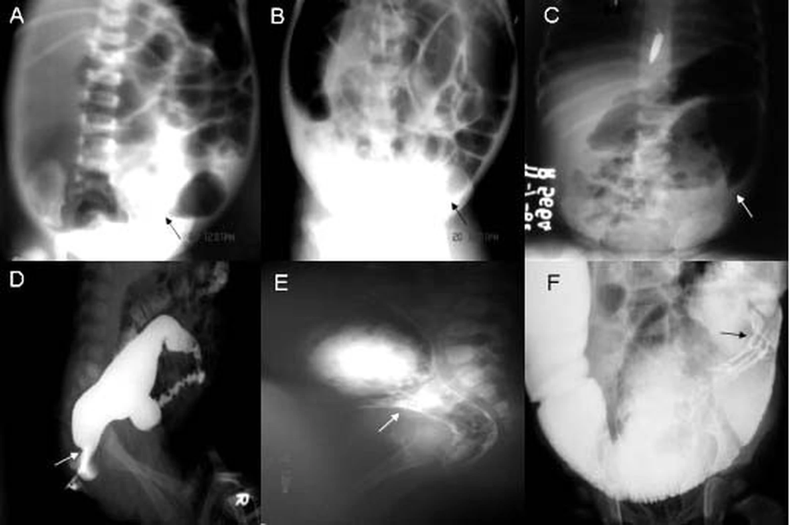 Contrast enema showing a narrow distal segment and dilated proximal colon in Hirschsprung disease