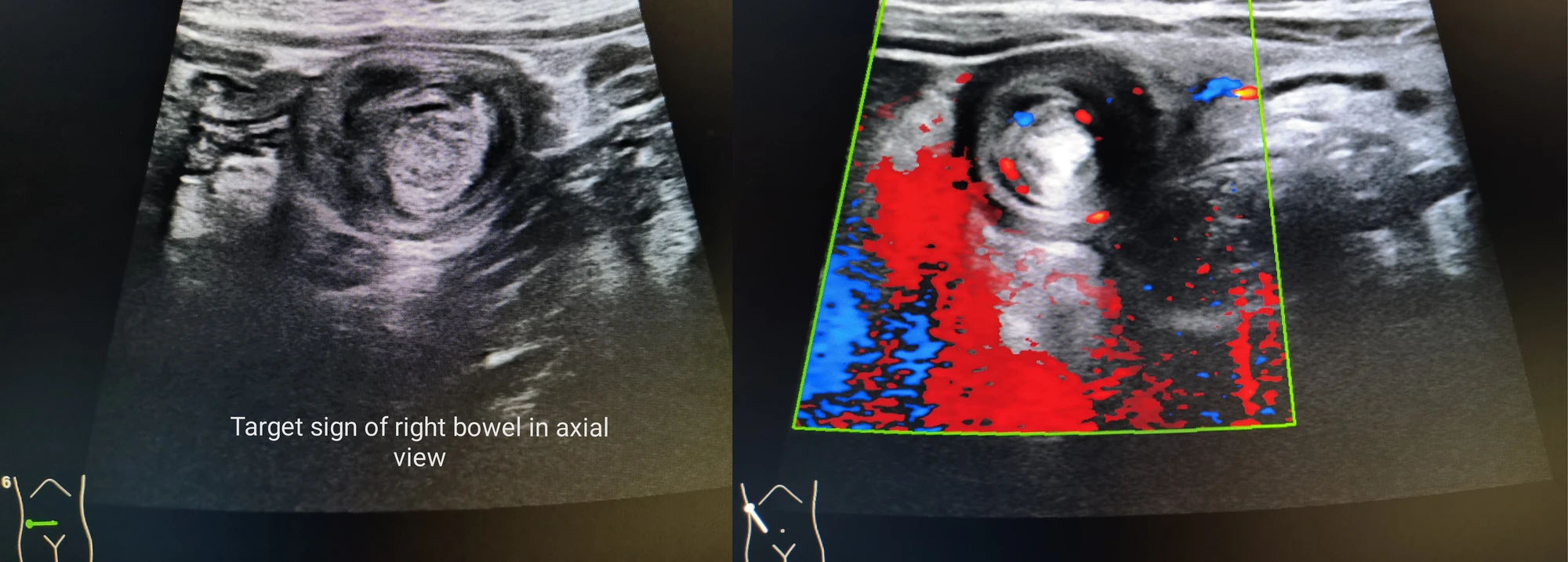 Ultrasound target sign produced by telescoped bowel loops