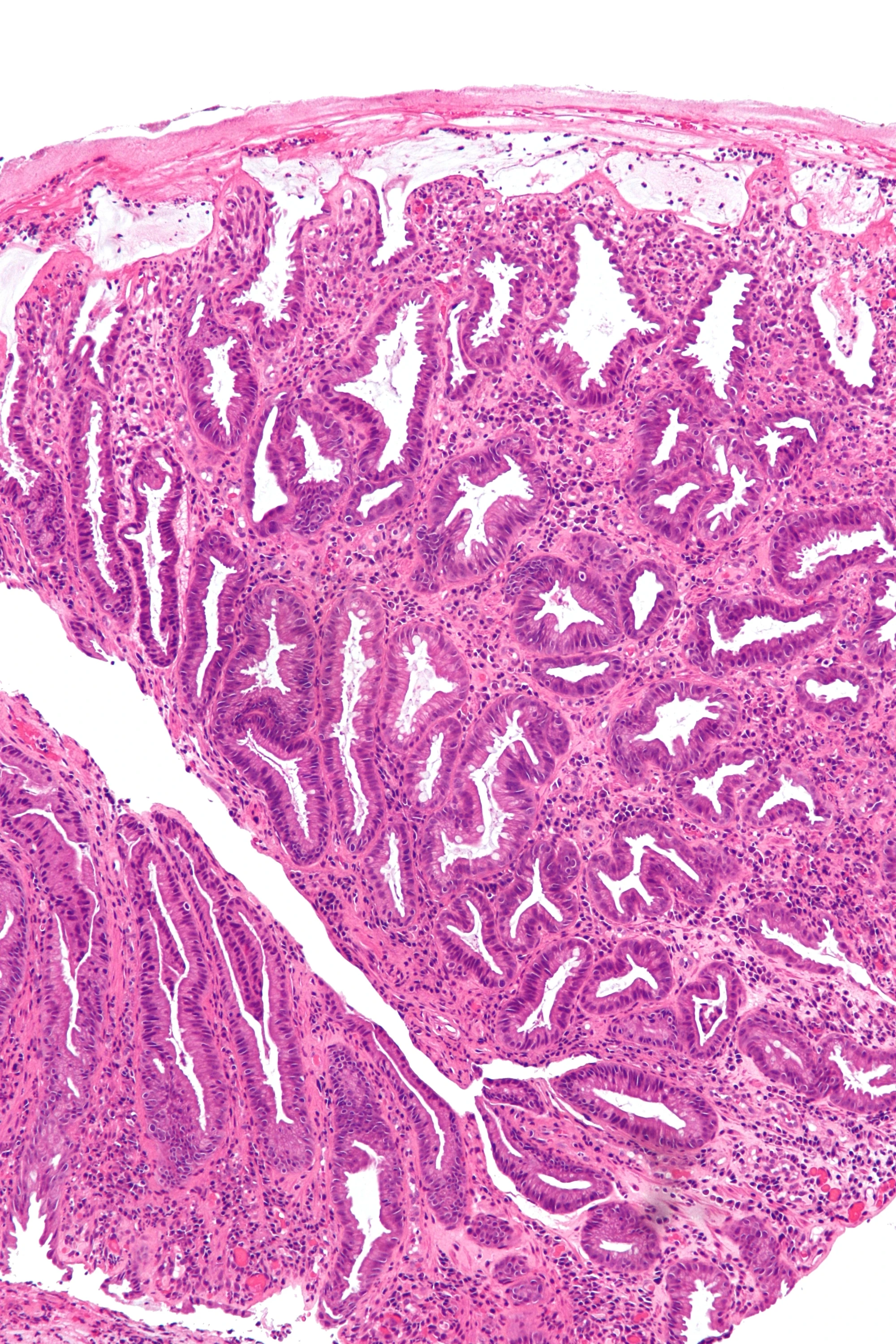 Colonic mucosa with ischemic crypt injury and lamina propria change