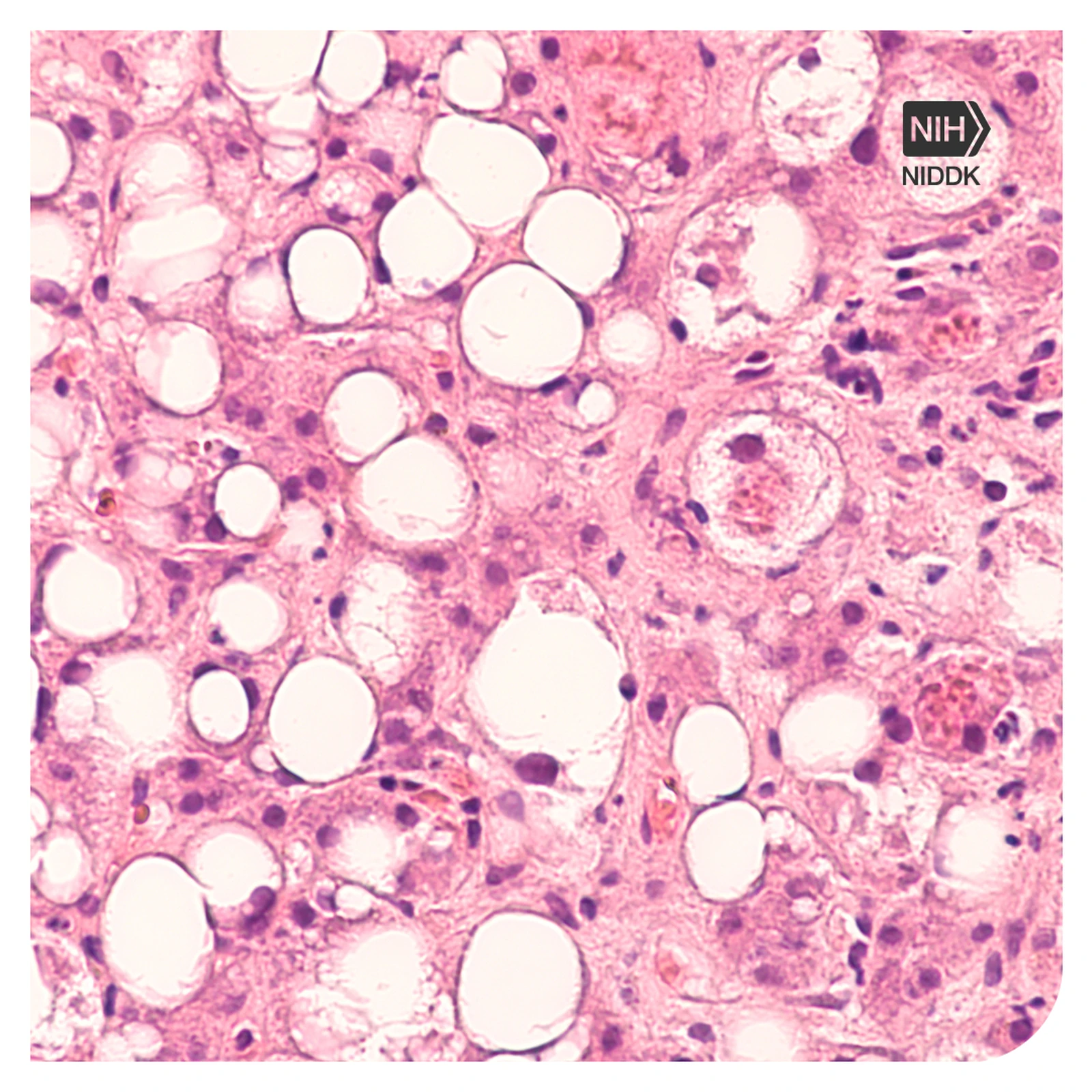 Liver core biopsy showing steatosis and Mallory-Denk material in alcohol-associated injury