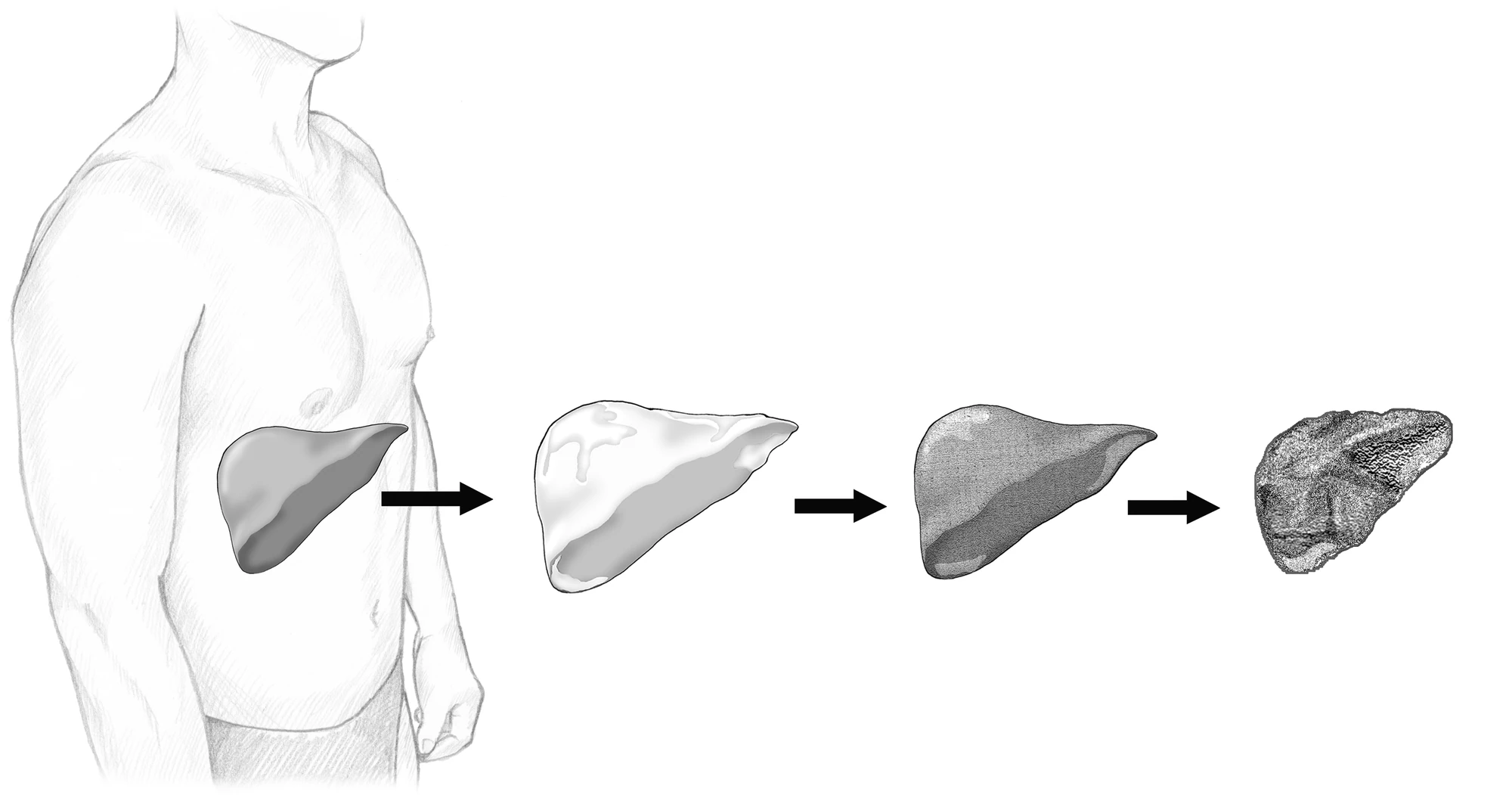Progression from normal liver through steatosis and fibrosis to cirrhosis