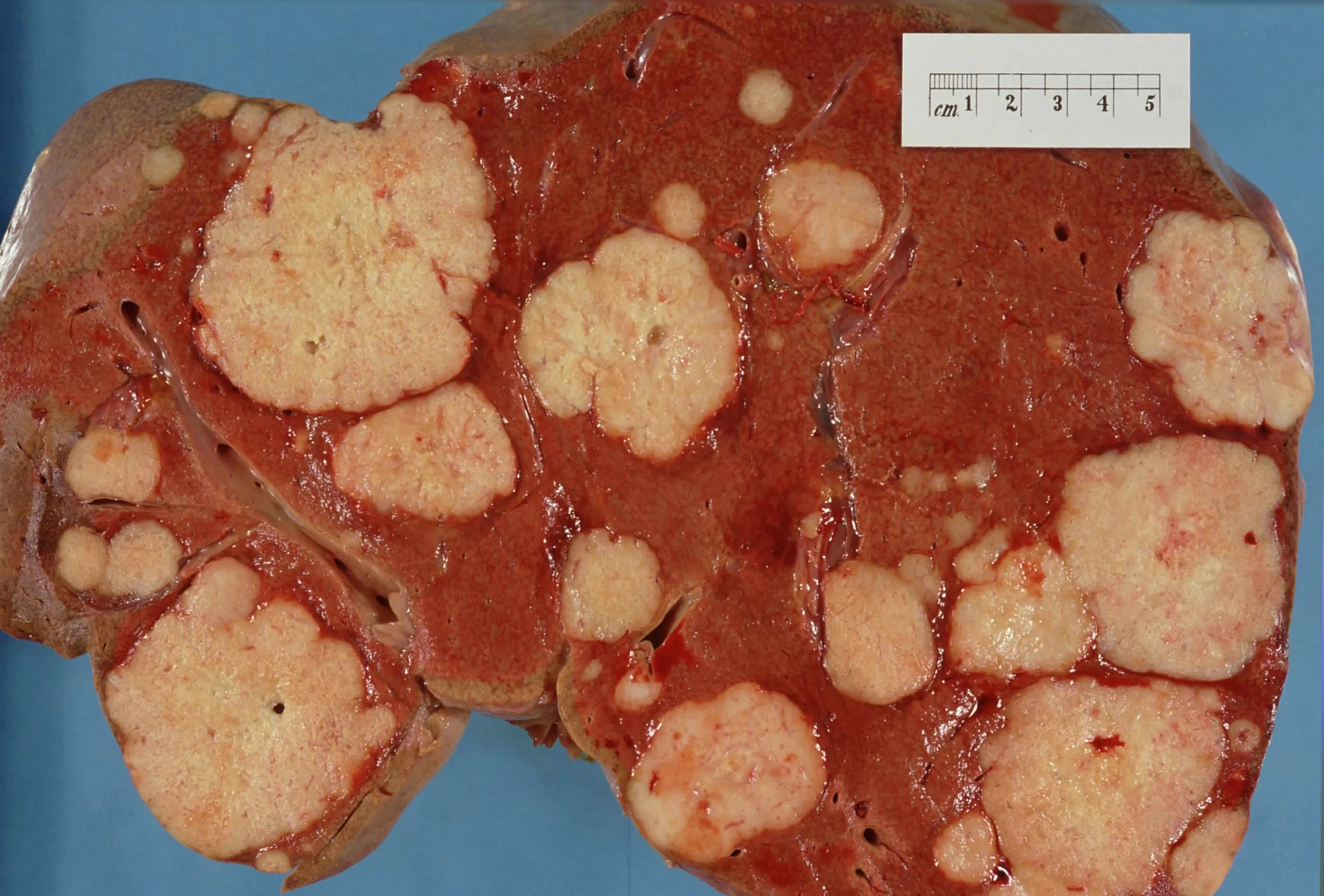 Liver containing multiple metastatic tumor deposits