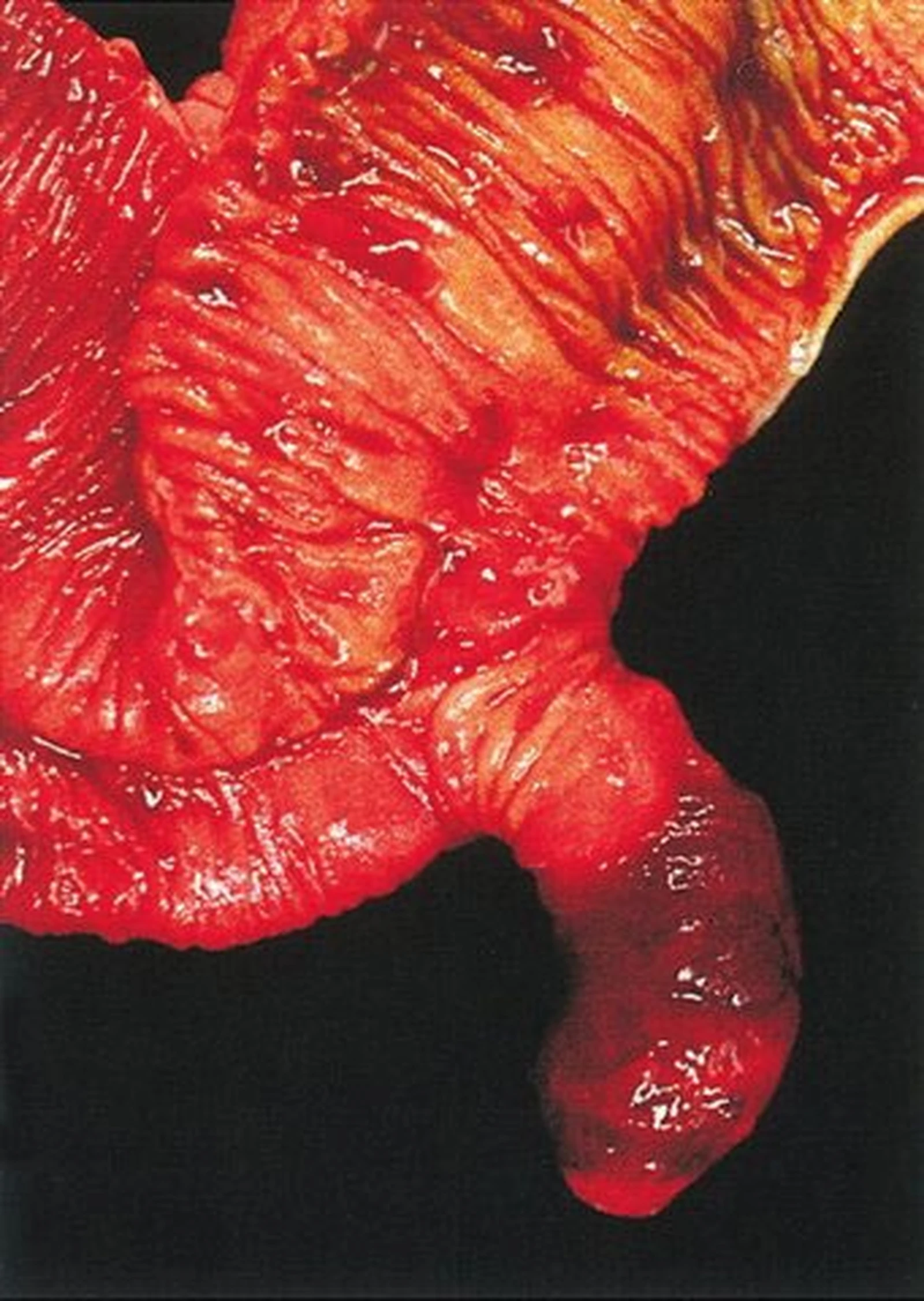 Gross specimen of a Meckel diverticulum projecting from ileum