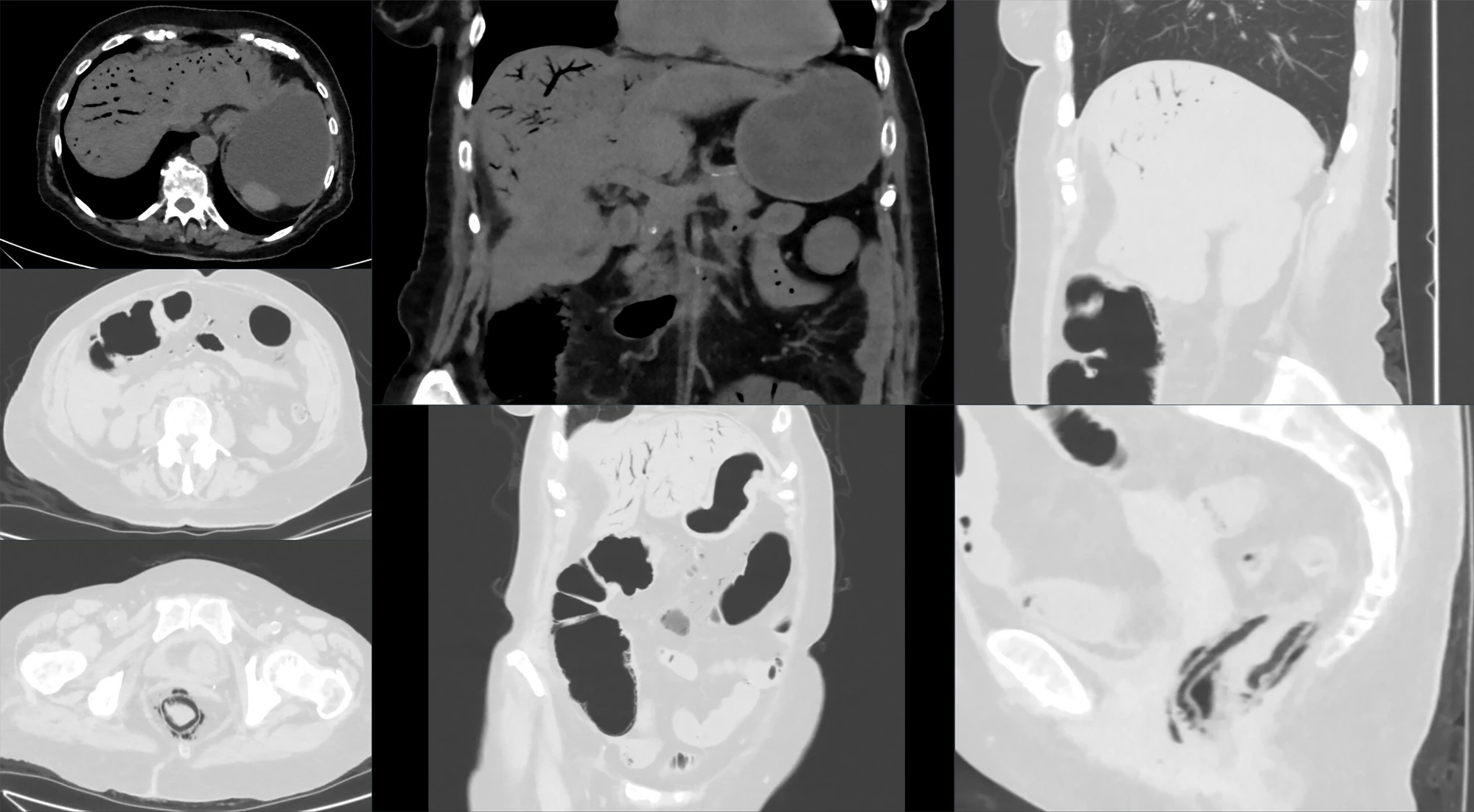 CT showing pneumatosis with mesenteric and portal venous gas in advanced bowel ischemia