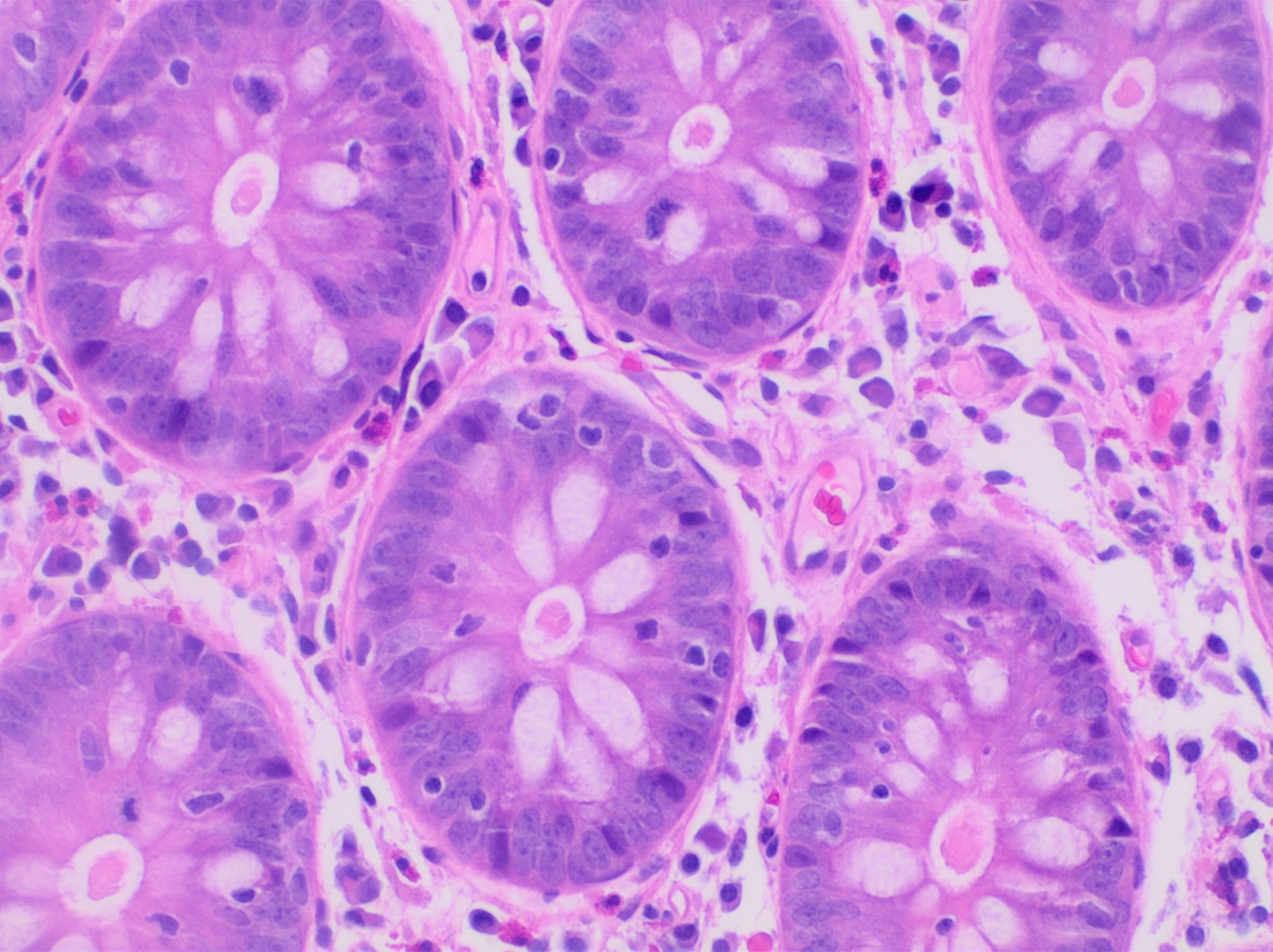 Colonic biopsy showing increased intraepithelial lymphocytes in lymphocytic colitis