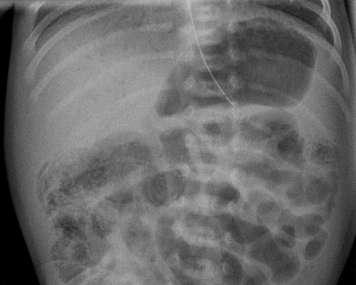 Neonatal abdominal radiograph showing pneumatosis intestinalis and portal venous gas