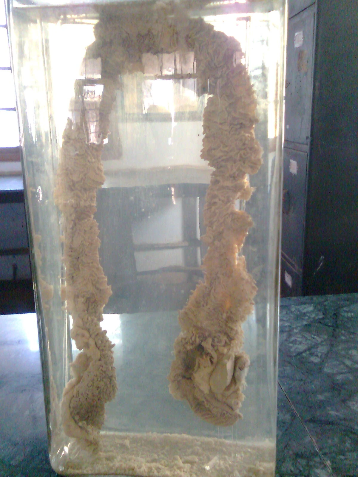 Colon densely carpeted by adenomatous polyps in familial polyposis