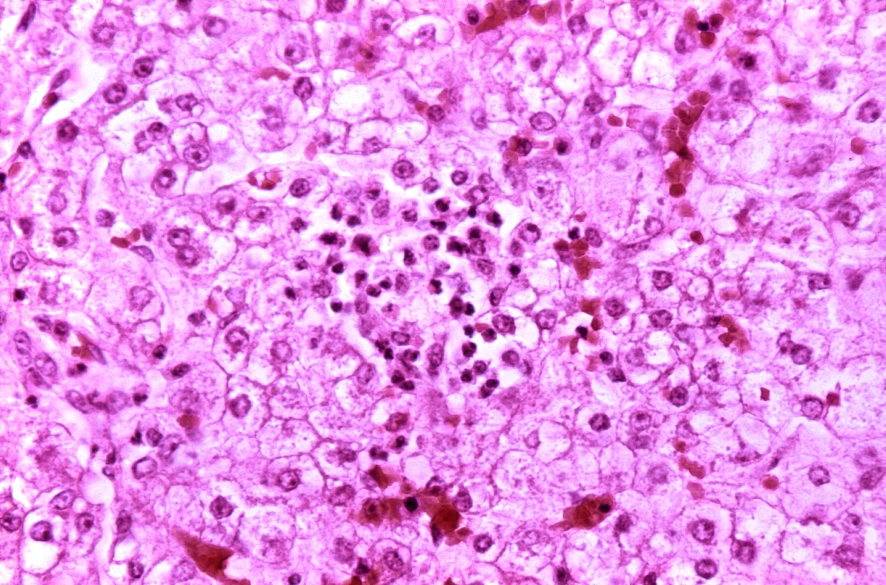 Liver histology showing diffuse microvesicular steatosis in Reye syndrome