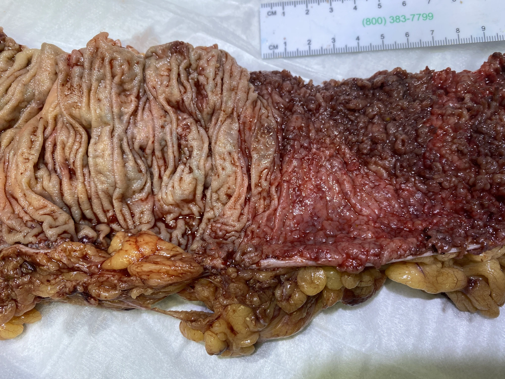 Severe ulcerative colitis with diffusely inflamed, friable colonic mucosa