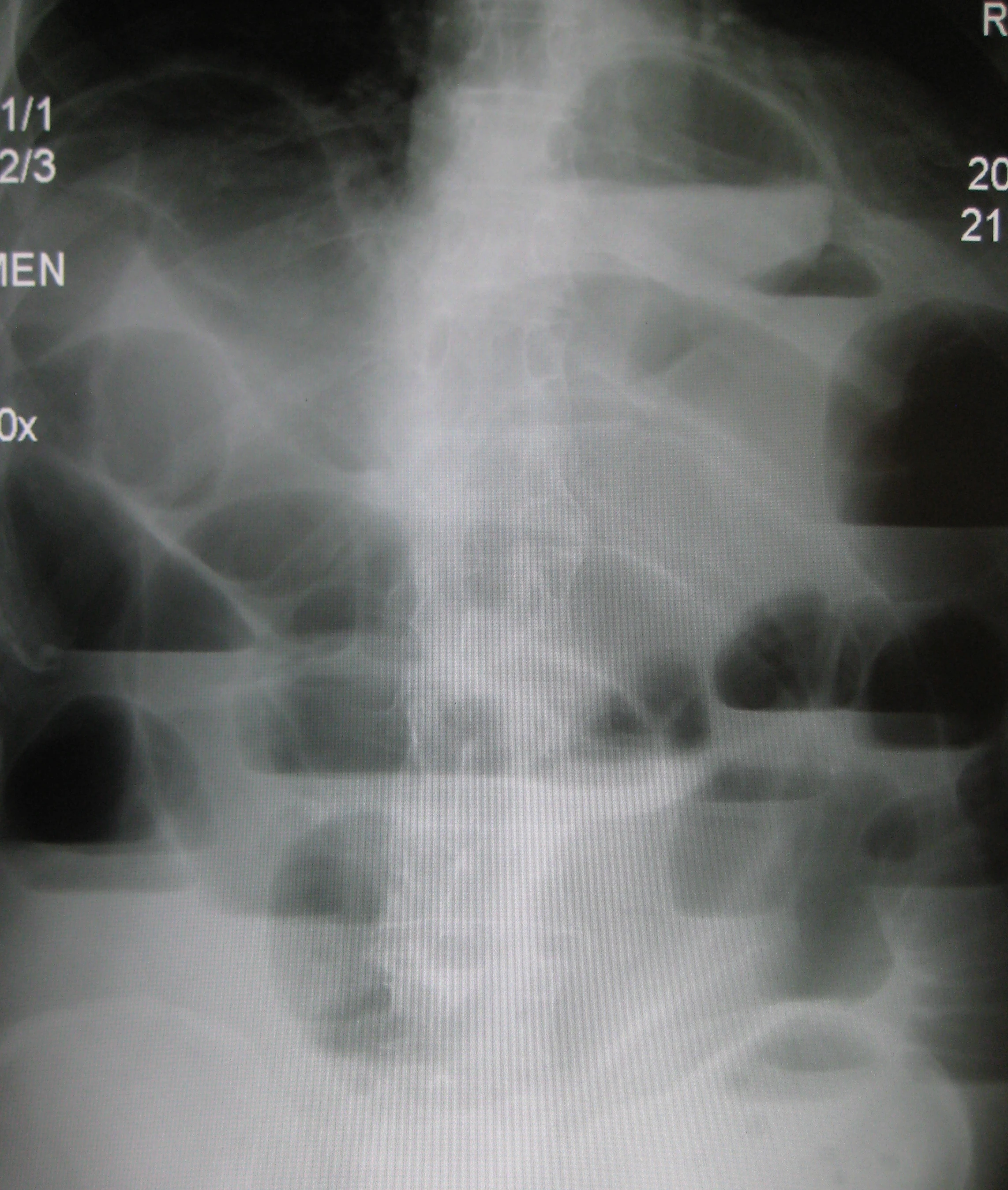 Upright abdominal radiograph with dilated small bowel and multiple air-fluid levels