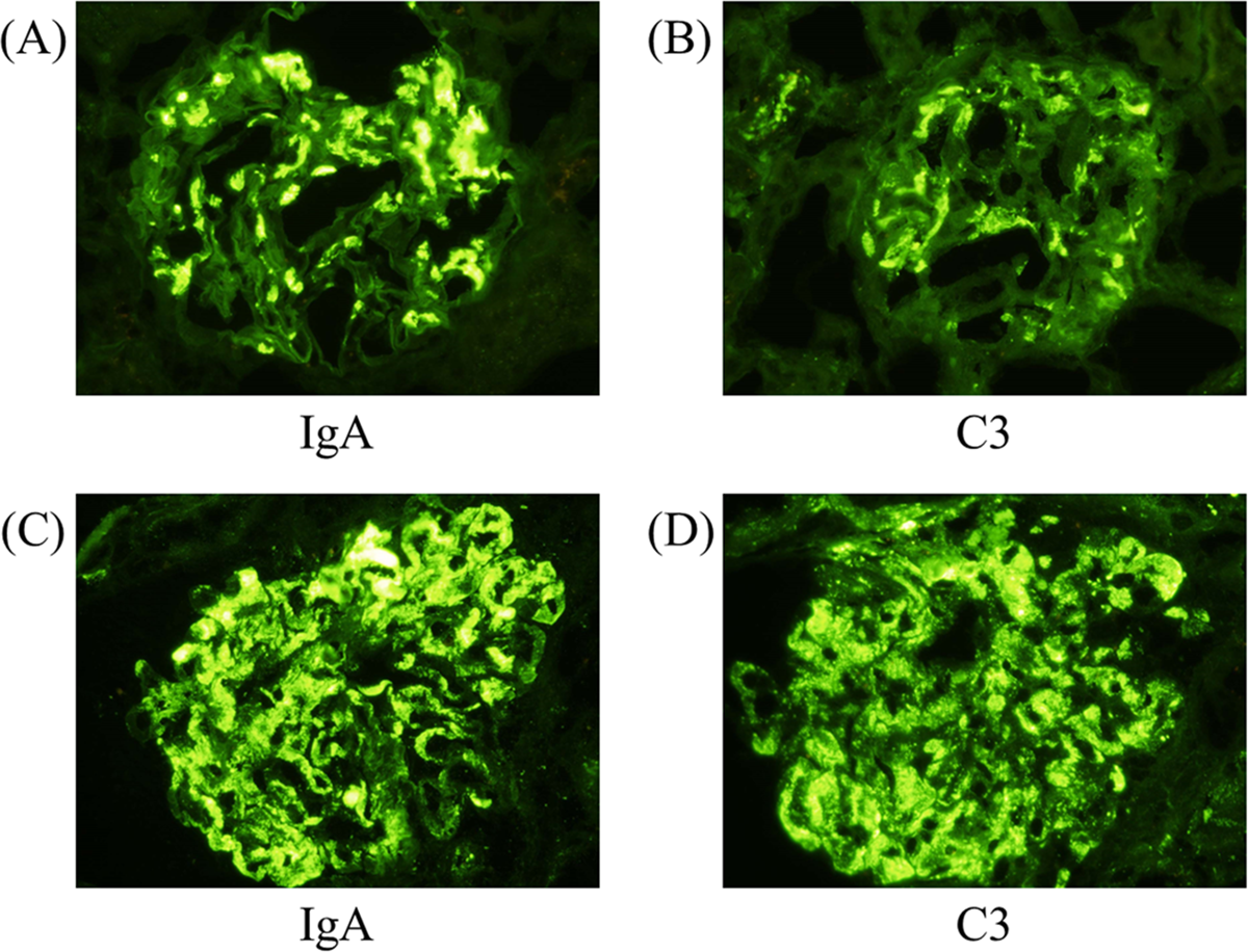 Four renal immunofluorescence panels: A and C stain IgA; B and D stain C3. The upper pair has mesangial staining; the lower pair also stains capillary walls.