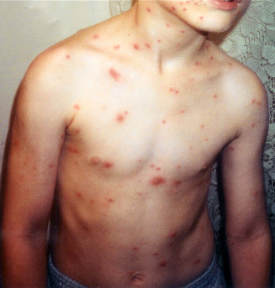 Child with chickenpox vesicular rash
