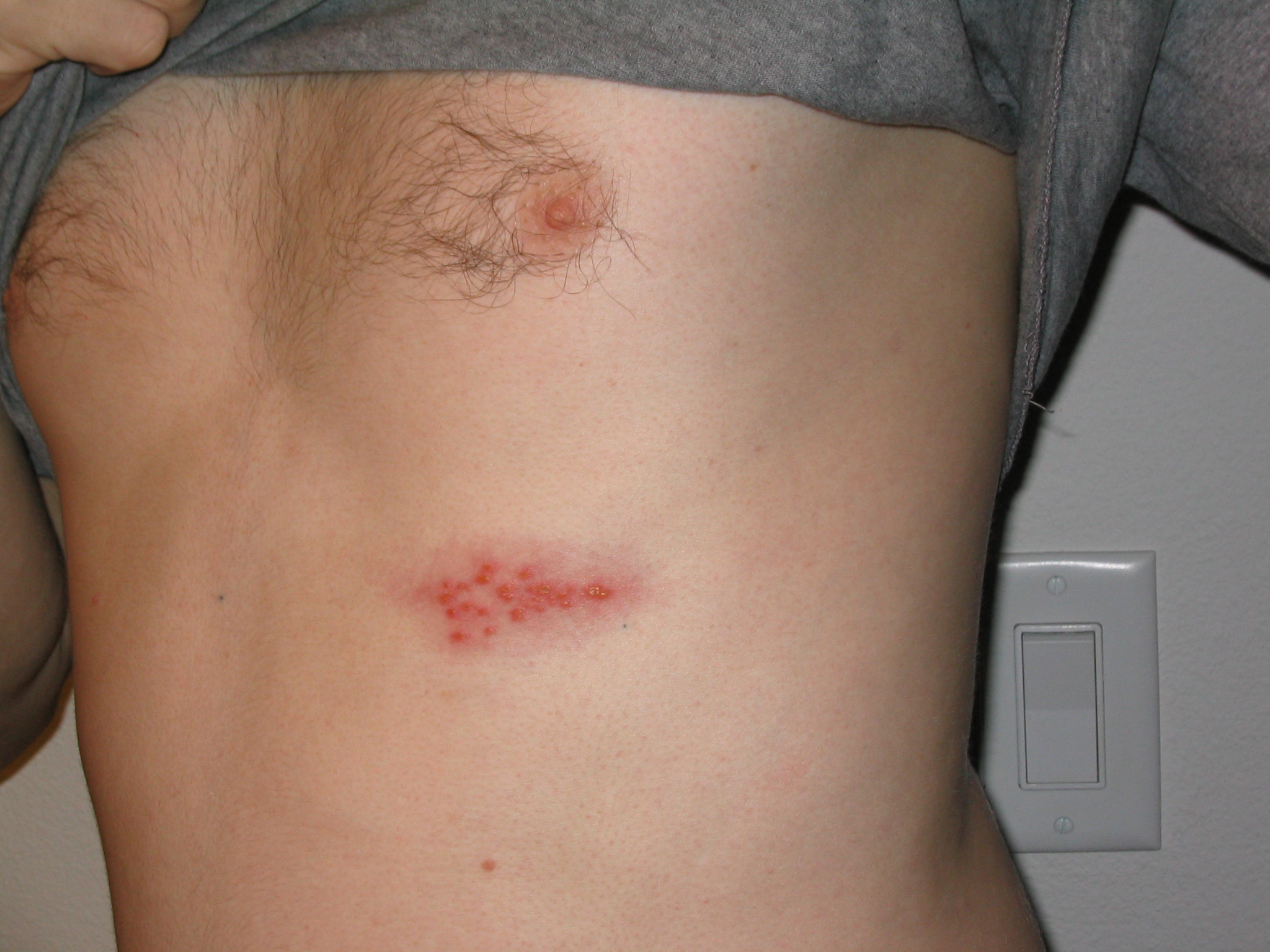 Dermatomal shingles on chest