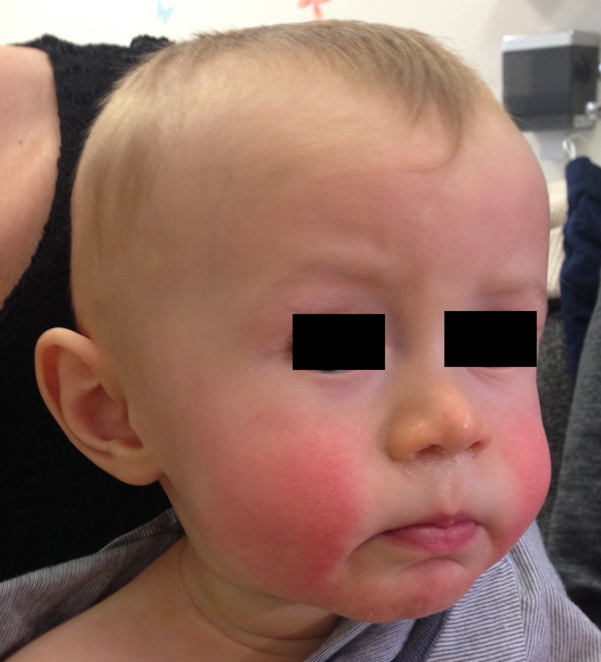 Slapped cheek appearance in fifth disease