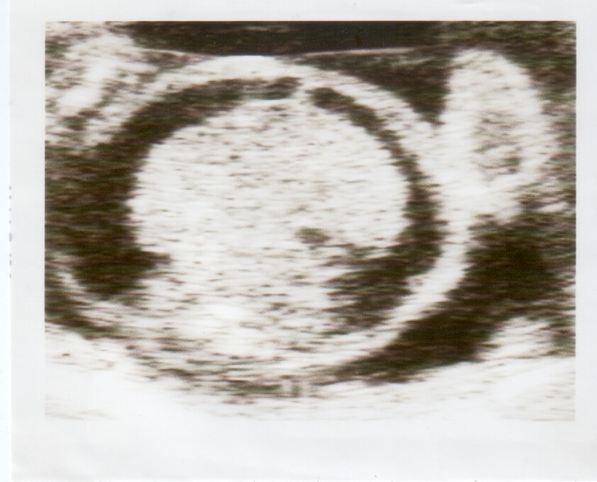 Hydrops fetalis ultrasound