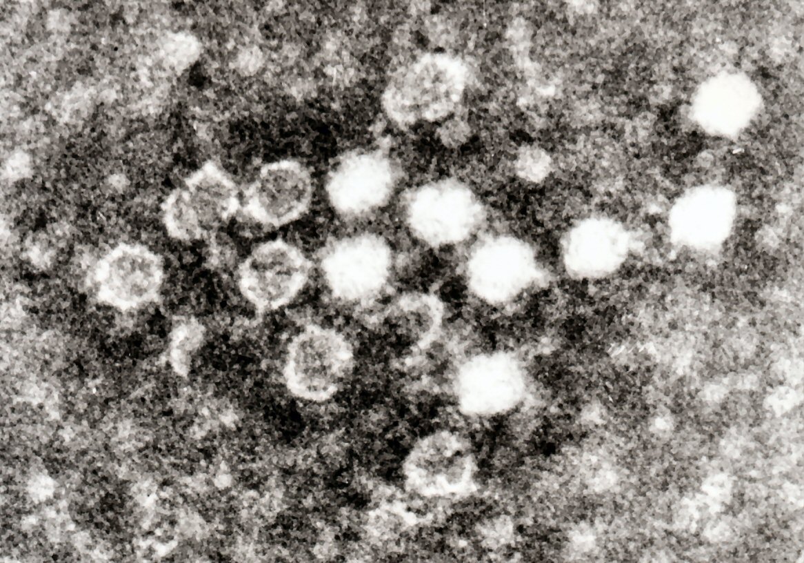 Parvovirus B19 EM