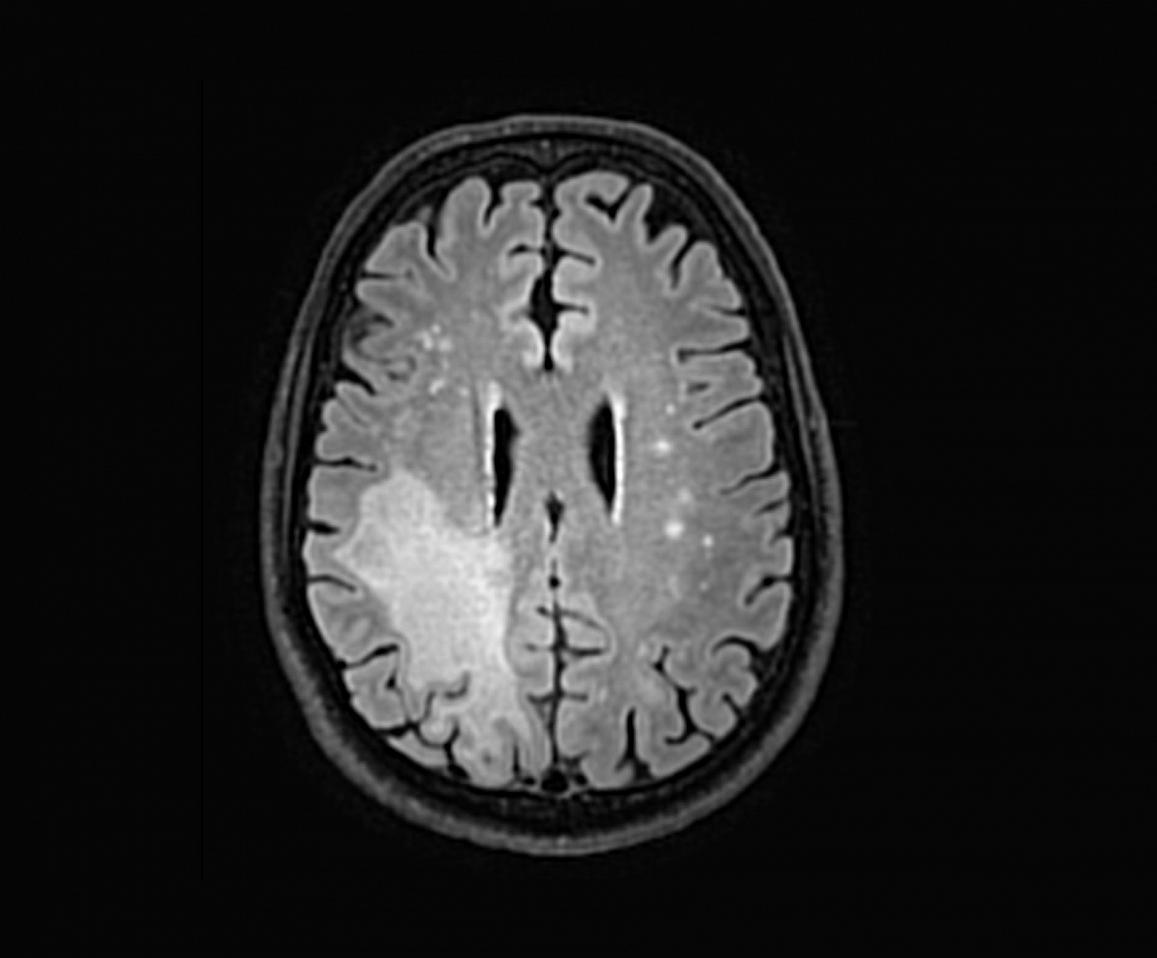 PML on MRI