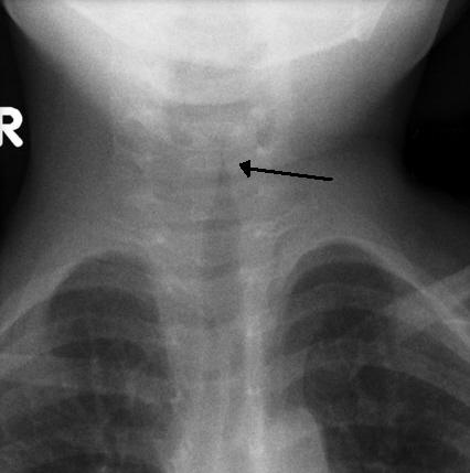 Steeple sign on AP neck X-ray