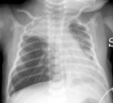 Bronchiolitis CXR with hyperinflation