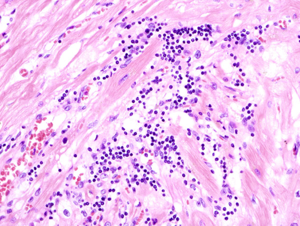 Viral myocarditis histology