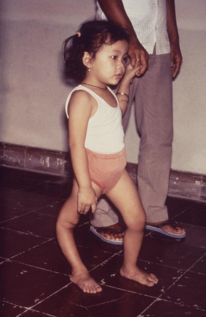 Post-polio leg atrophy