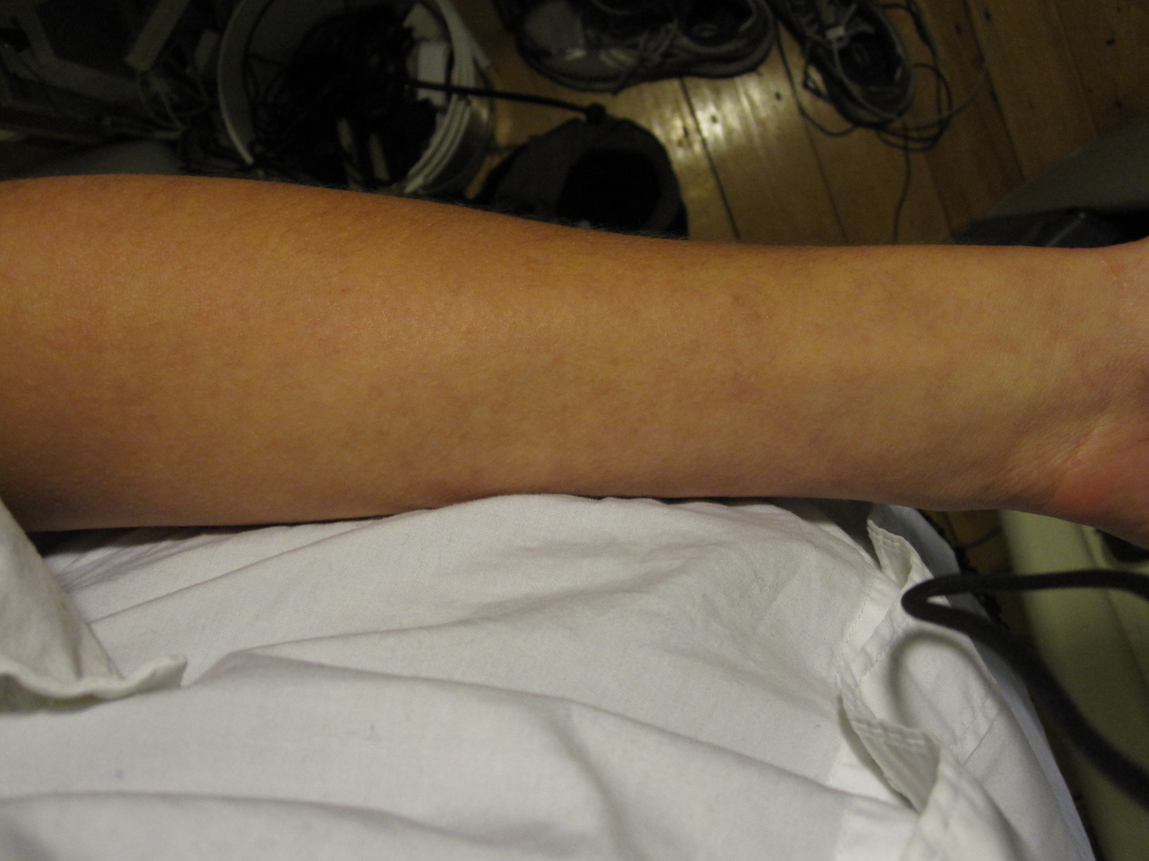 Dengue fever maculopapular rash