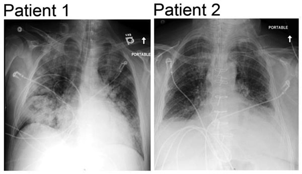 Chest radiographs from severe adenovirus pneumonia