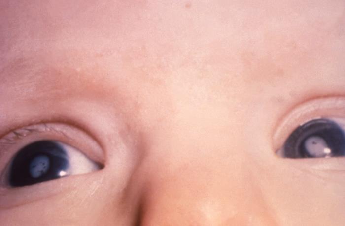 Congenital rubella cataracts