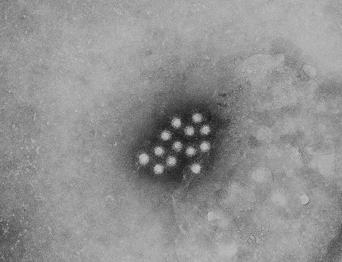 Chronic hepatitis B liver pathology