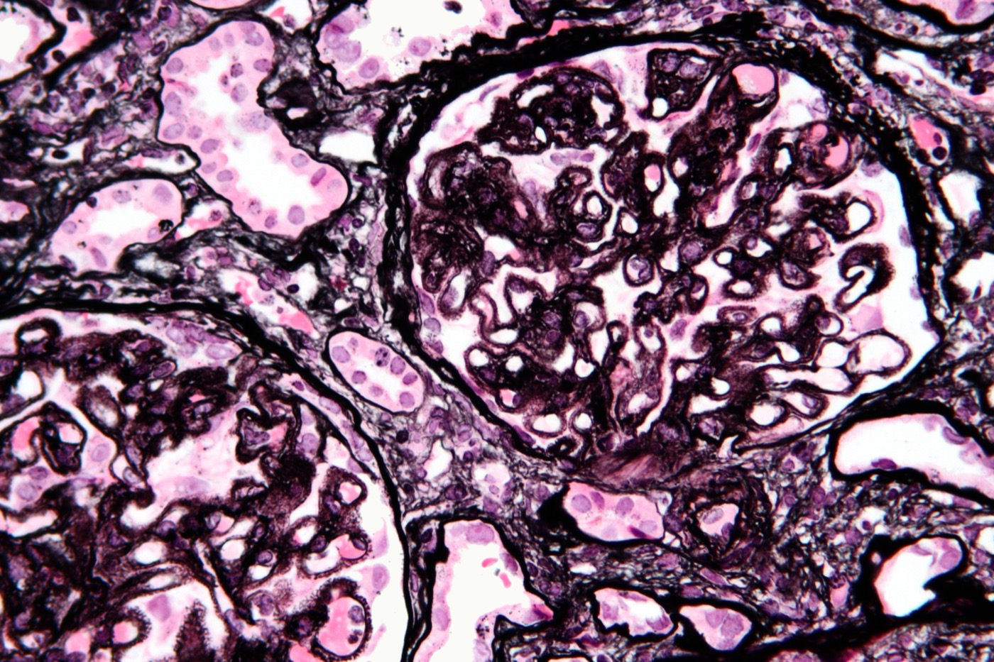Membranous nephropathy