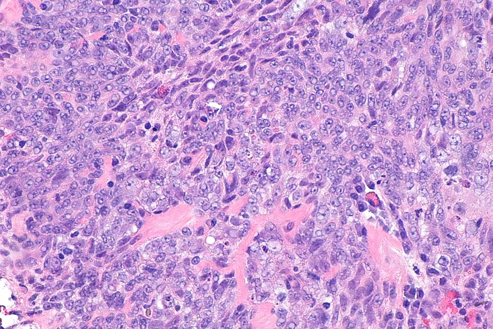 Nasopharyngeal carcinoma histology (EBV)