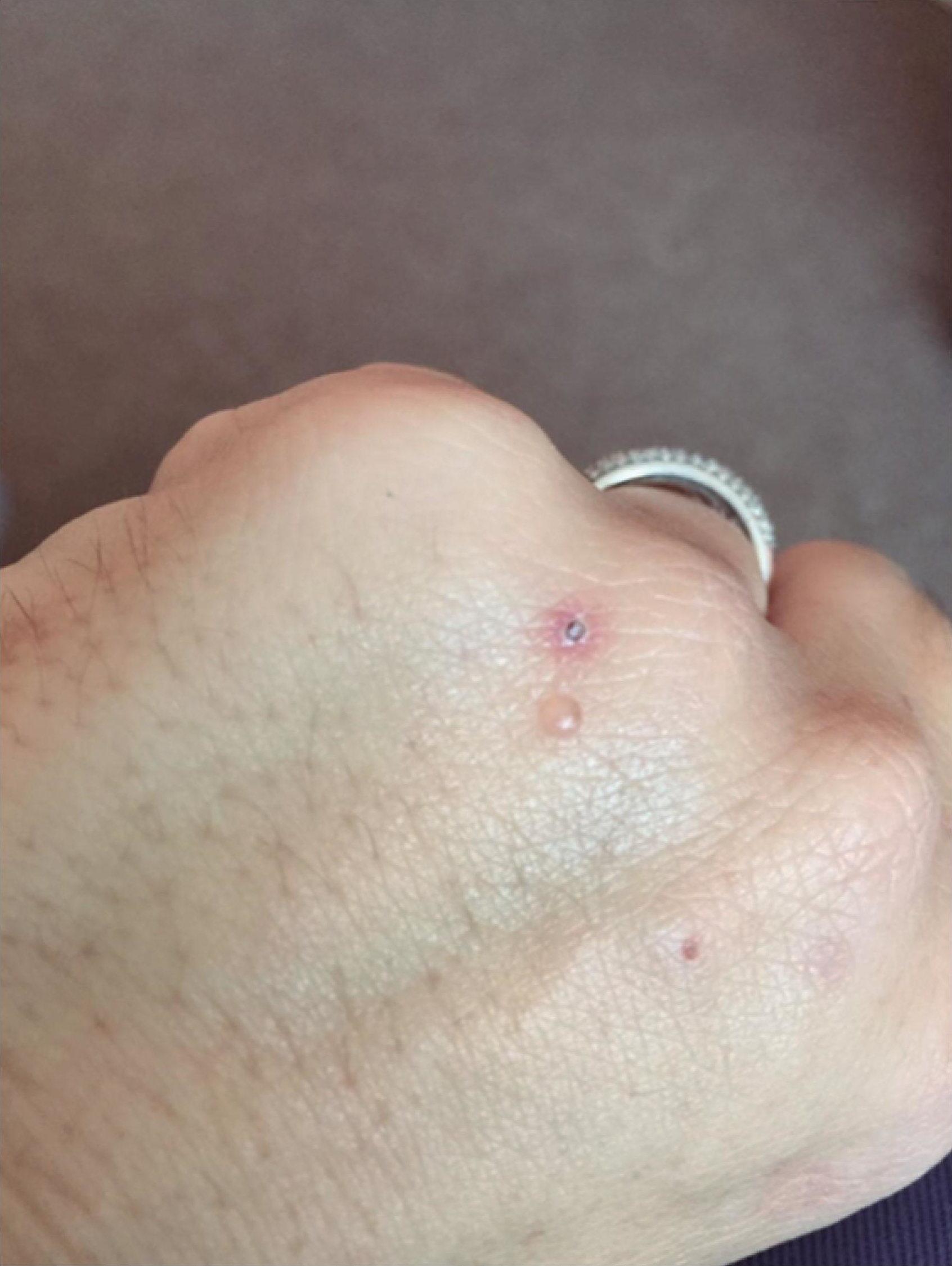 Porphyria cutanea tarda hand blisters (HCV-associated)