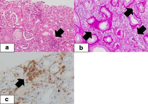 Three renal biopsy panels. In a, an arrow points to dense interstitial inflammatory cells; b shows tubular invasion and injury at arrows; c shows CD4-positive inflammatory cells.