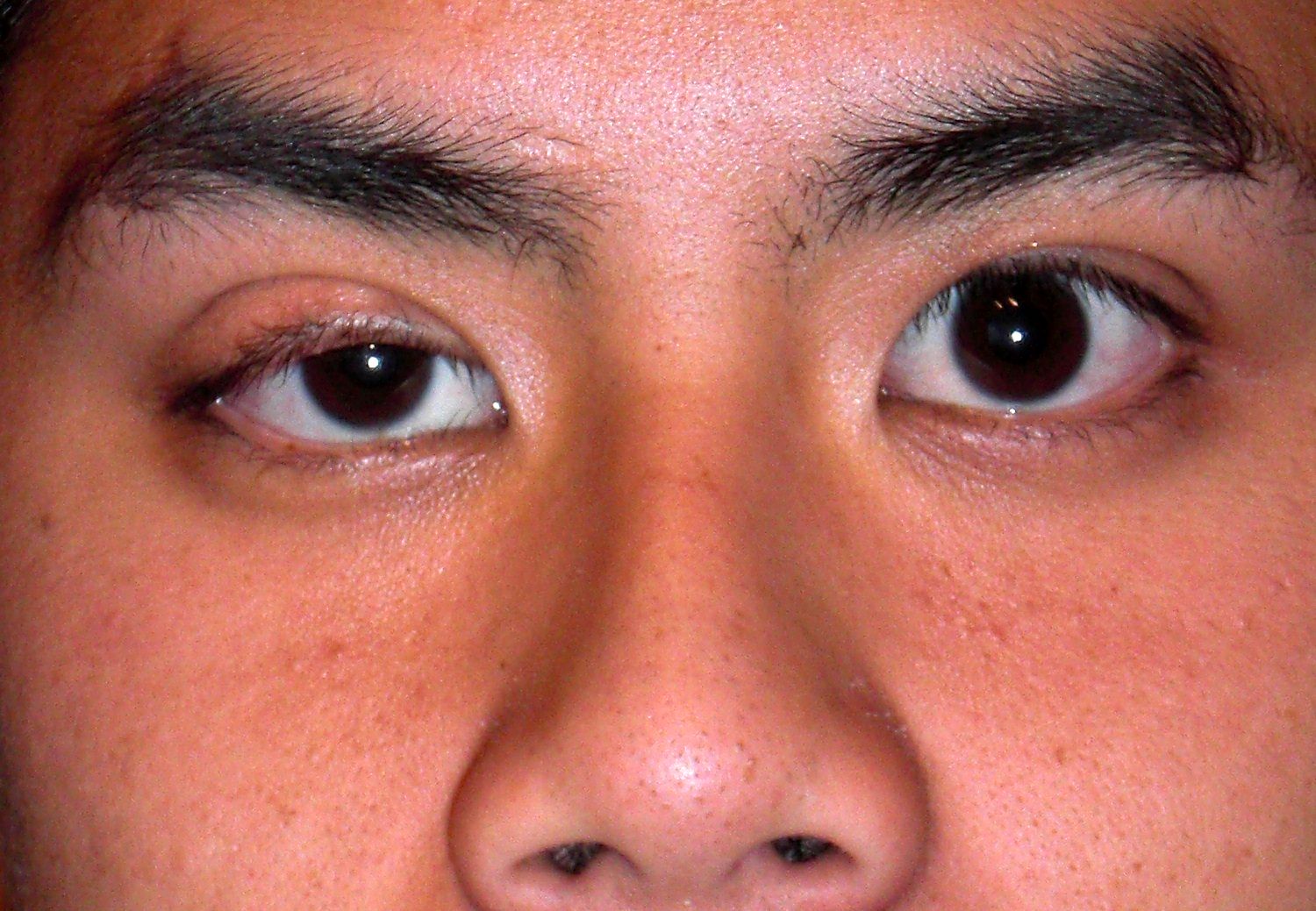 Ptosis photo showing a drooping upper eyelid