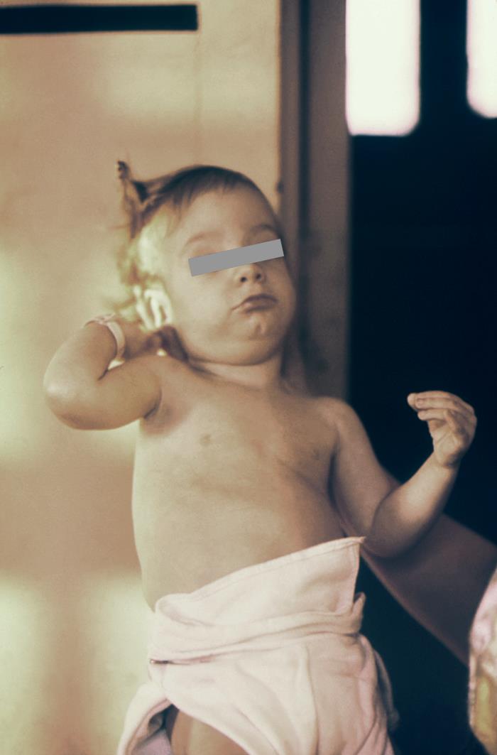 18-month-old with congenital cataracts