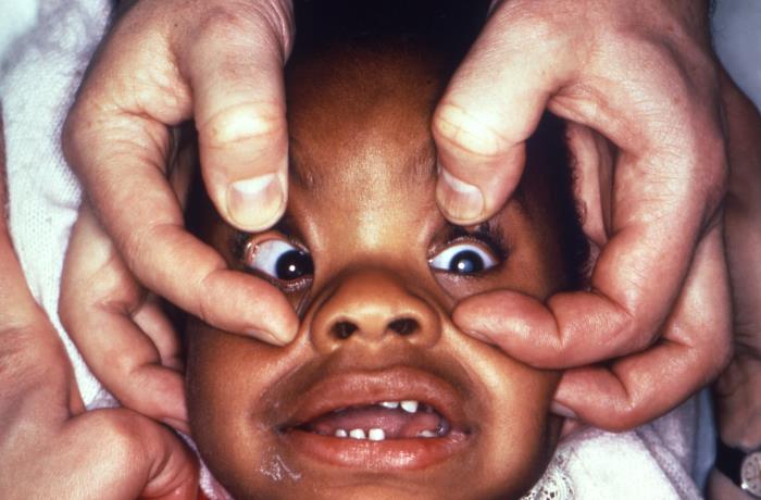 Bilateral congenital cataracts in a 7-month-old infant