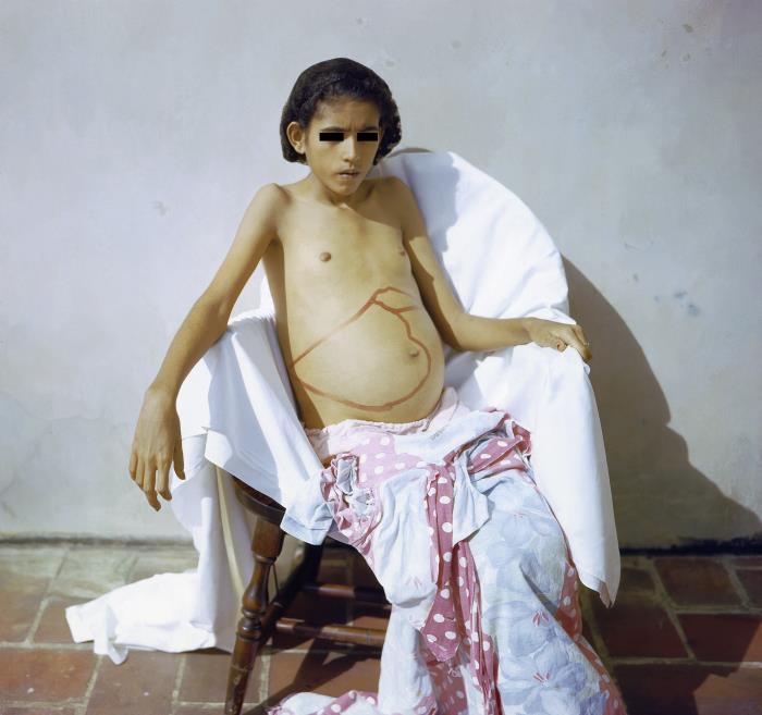 Infant with hepatosplenomegaly showing abdominal distension