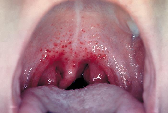 Intraoral petechiae: mucosal pinpoint hemorrhages indicating primary hemostatic defect