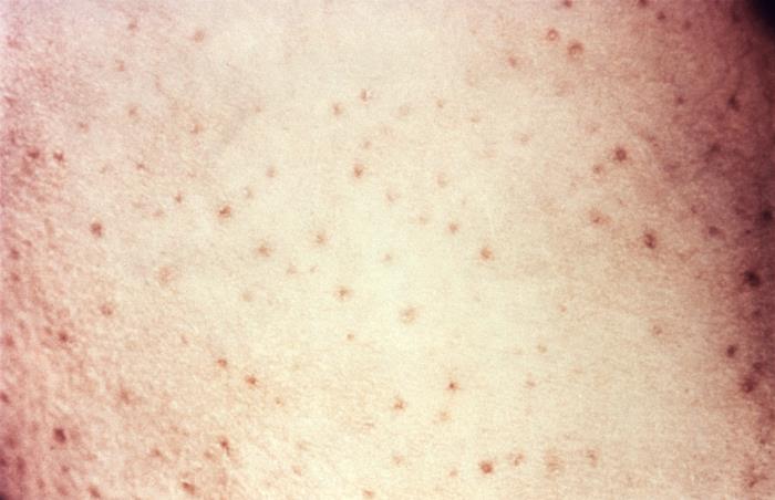 Petechiae: pinpoint non-blanching hemorrhages on skin from platelet failure