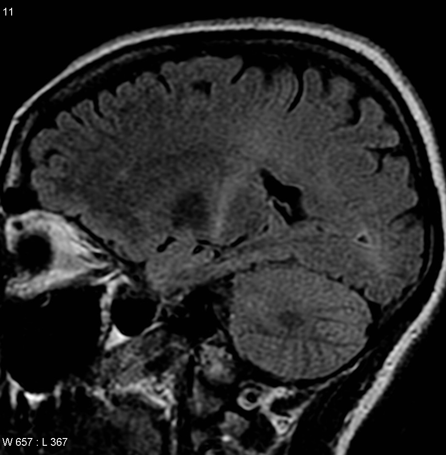ALS spinal cord section showing corticospinal tract pallor