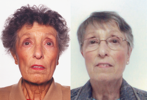 Facial and generalized hyperpigmentation in Addison disease, before and after