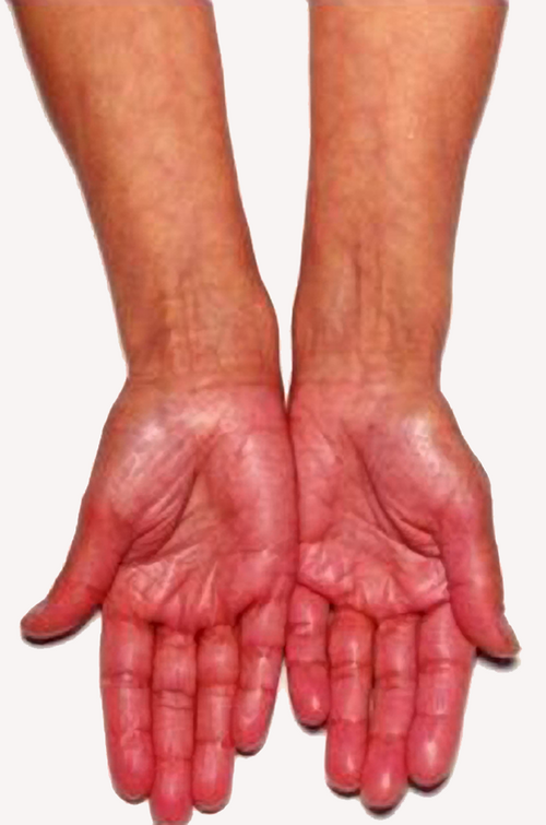Hyperpigmented palms and palmar creases in Addison disease
