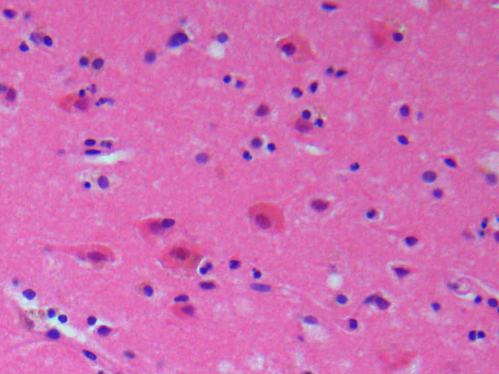 Brain ischemia histology