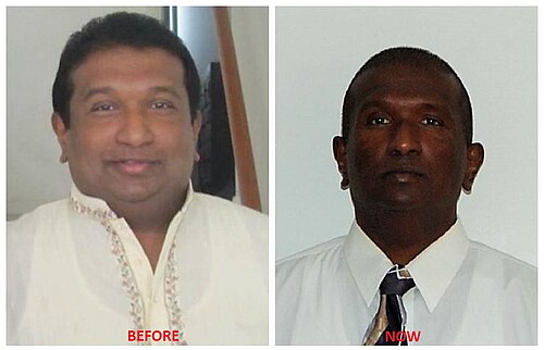 Generalized hyperpigmentation of the skin in Addison disease
