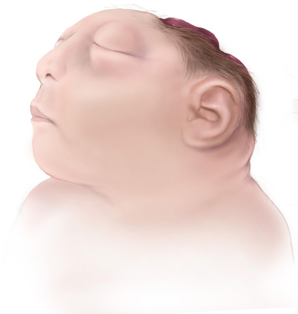 Anencephaly illustration