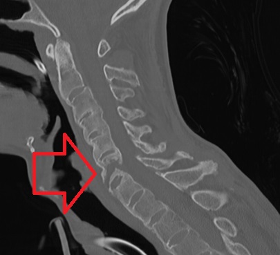 Ankylosing Spondylitis bamboo spine X-ray