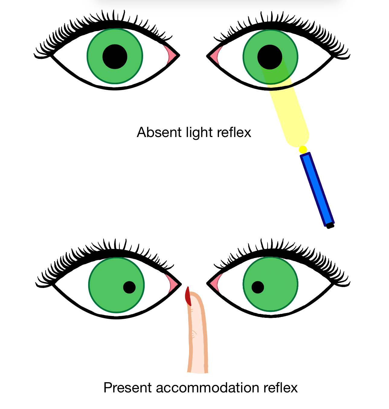 Argyll Robertson pupils